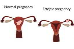 Grossesse extra-uterine