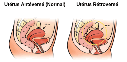 Uterus Retroverse Quels Symptomes Quels Traitements Ivi France
