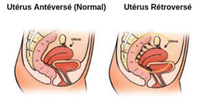 utérus rétroversé