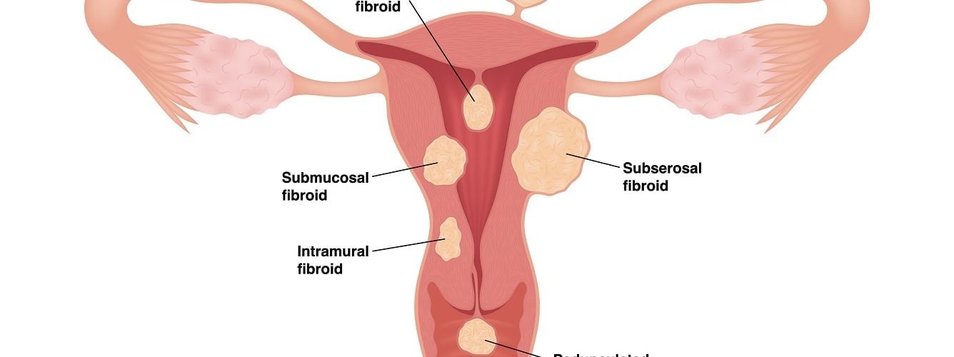 Que sont les fibromes et comment affectent-ils la grossesse ?