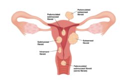Que sont les fibromes et comment affectent-ils la grossesse ?