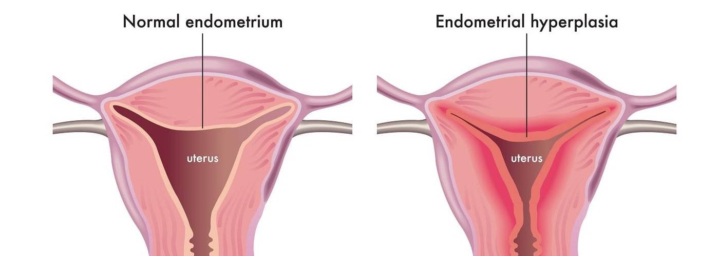 hyperplasie endometriale