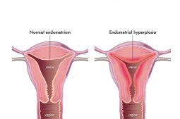 hyperplasie endometriale