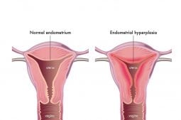 hyperplasie endometriale