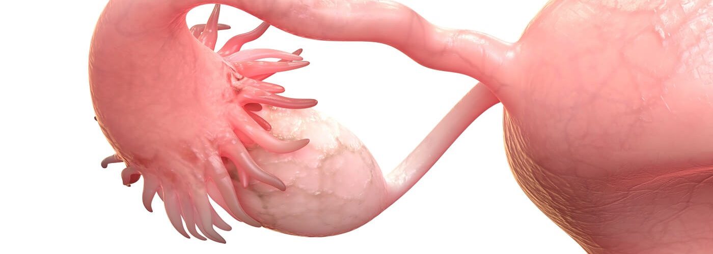 anovulation et infertilité