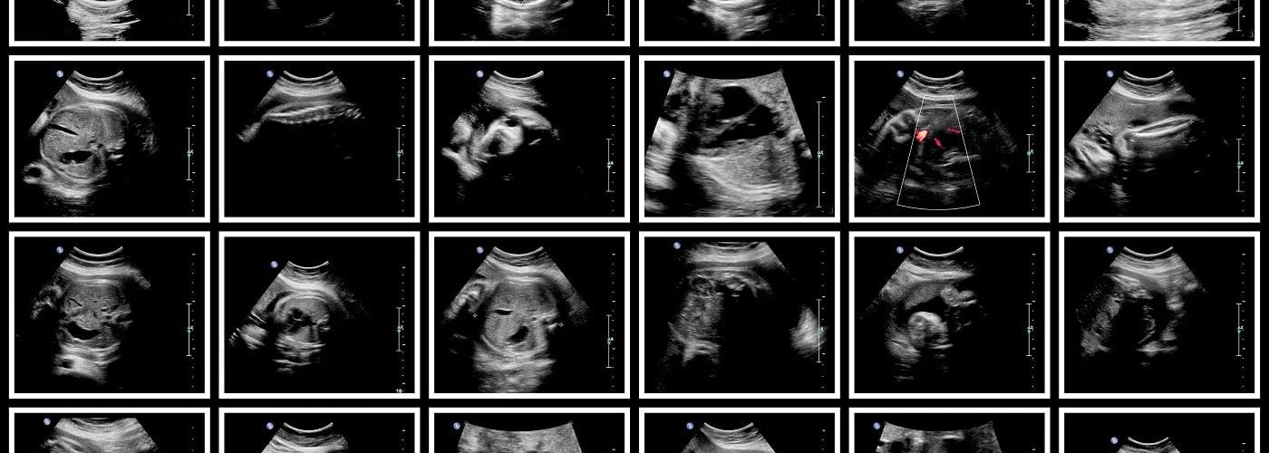 différence embryon fœtus