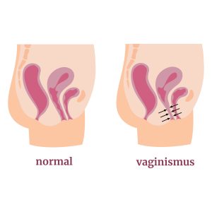 vaginisme gynecologie