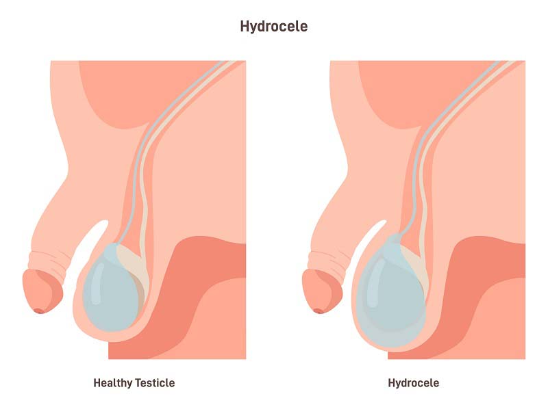 Hydrocèle : de quoi s'agit-il ? Symptômes et traitement