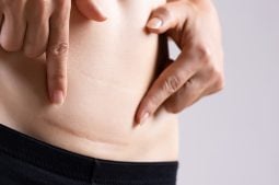 Qu’est-ce que l’isthmocèle et comment affecte-t-il la grossesse ?