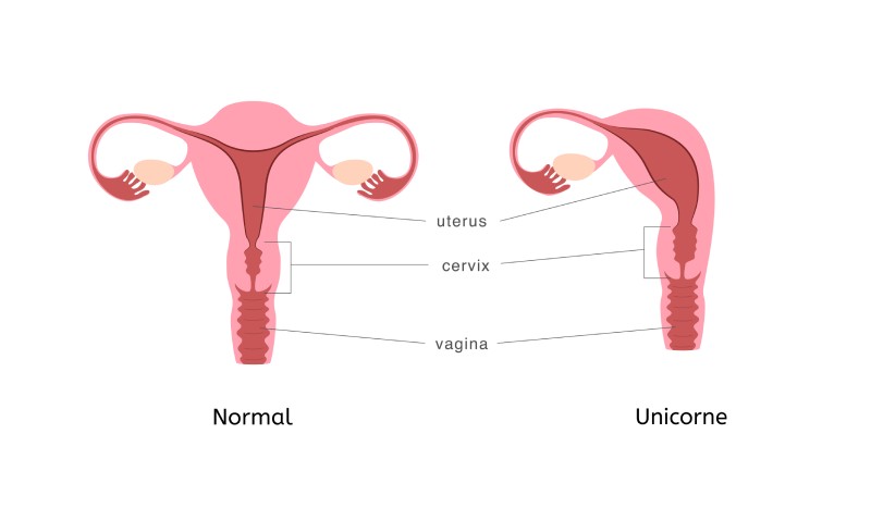 Utérus unicorne vs normal
