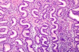 Le sang du cordon ombilical, clé de la régénération de l’endomètre chez les femmes atteintes de pathologies utérines complexes